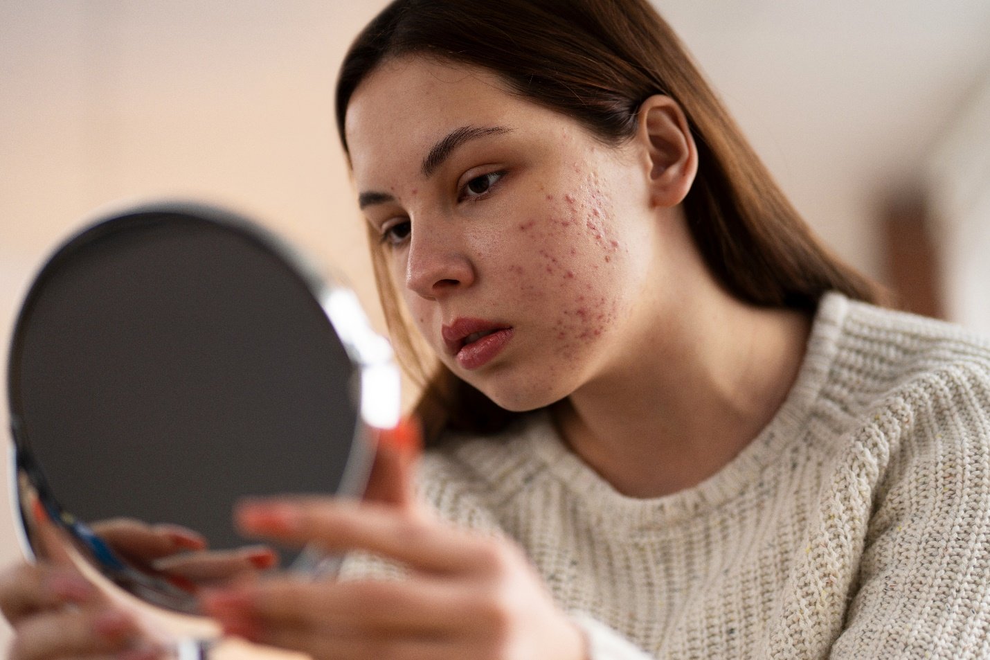Post Acne Marks Treatment in Jaipur