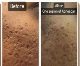 Acne Scar · 1 Session
