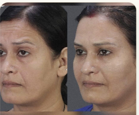 Anti-Ageing Treatment