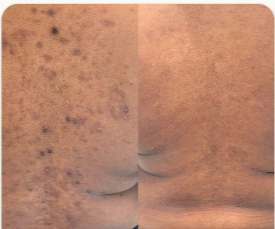 Body Acne & Pigmentation