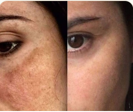 Pigmentation · Face