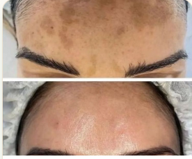 Pigmentation · Forehead