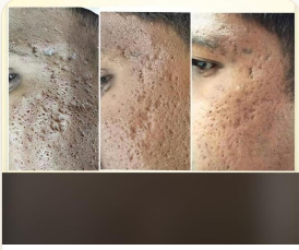 Post Acne Scars · GFC