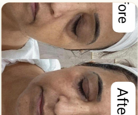 Skin Rejuvenation