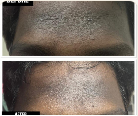 Skin Texture · 2 Sessions