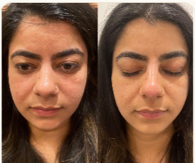 Skin Transformation