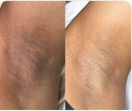 Underarm Pigmentation