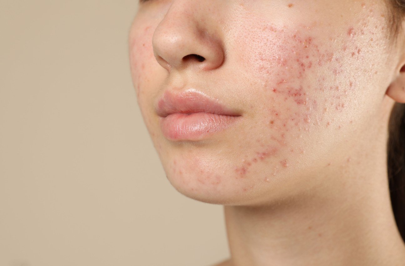 Acne scars and active breakouts treatment preview